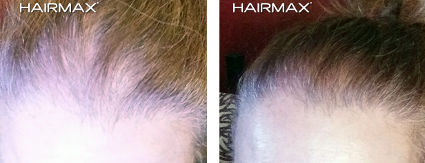 HairMax Before & After Results