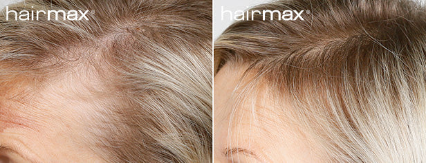 HairMax Before & After Results