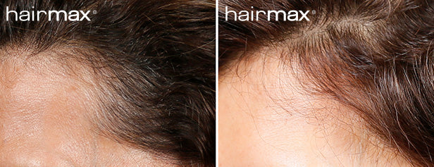 HairMax Before & After Results