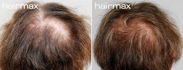 HairMax Before & After Results