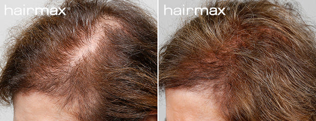 HairMax Before & After Results