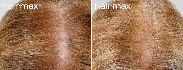 HairMax Before & After Results