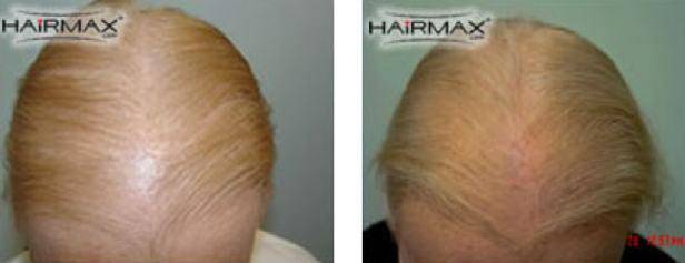 HairMax Before & After Results