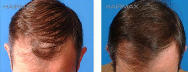 HairMax Before & After Results