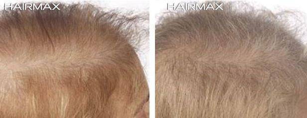 HairMax Before & After Results
