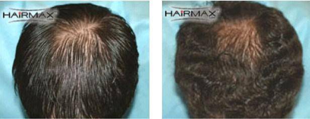 HairMax Before & After Results