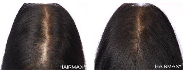 HairMax Before & After Results