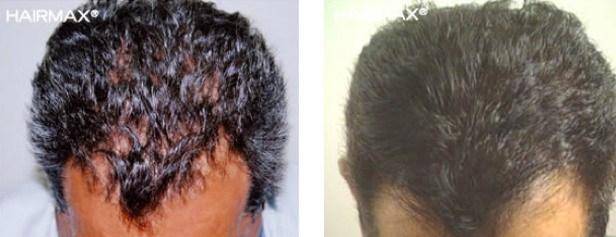 HairMax Before & After Results