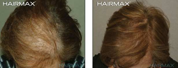 HairMax Before & After Results
