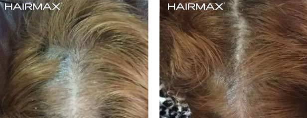 HairMax Before & After Results