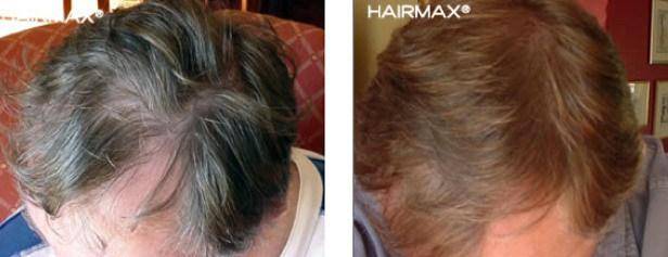 HairMax Before & After Results