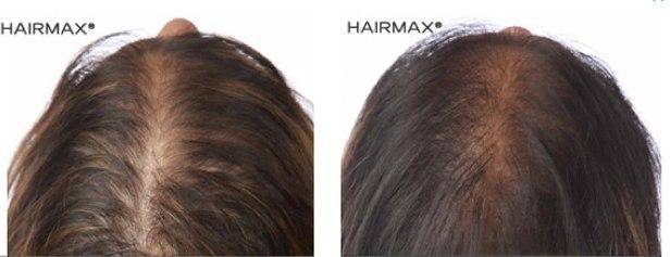 HairMax Before & After Results