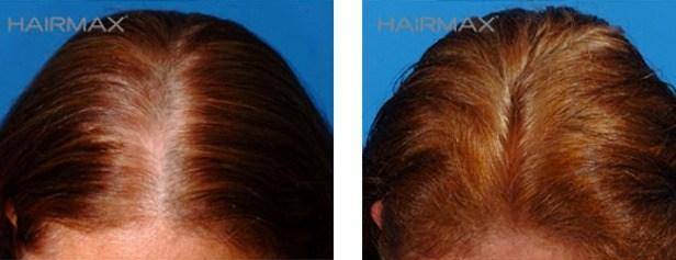 HairMax Before & After Results