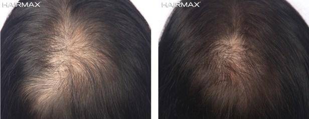 HairMax Before & After Results
