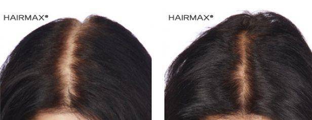 HairMax Before & After Results