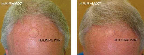 HairMax Before & After Results