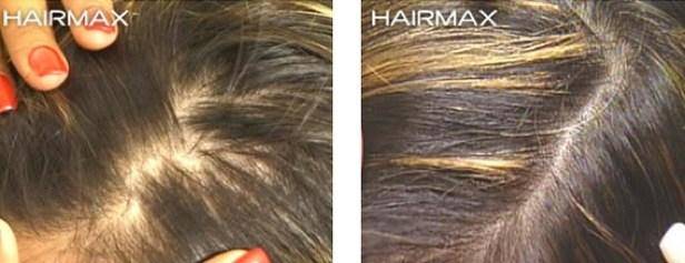 HairMax Before & After Results