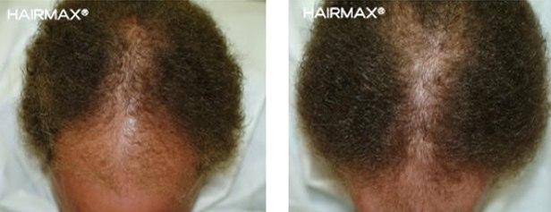 HairMax Before & After Results