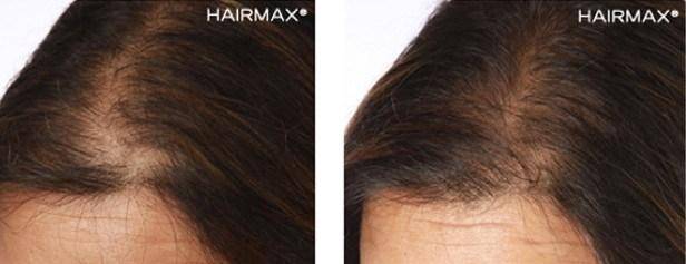 HairMax Before & After Results