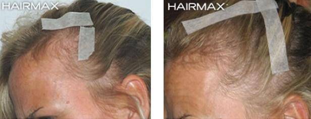 HairMax Before & After Results