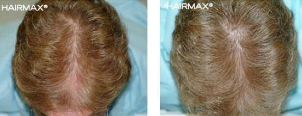HairMax Before & After Results