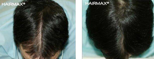 HairMax Before & After Results