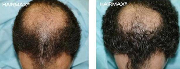 HairMax Before & After Results