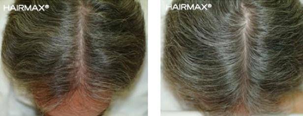 HairMax Before & After Results