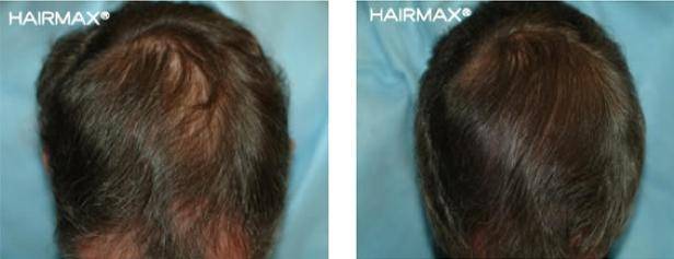 HairMax Before & After Results