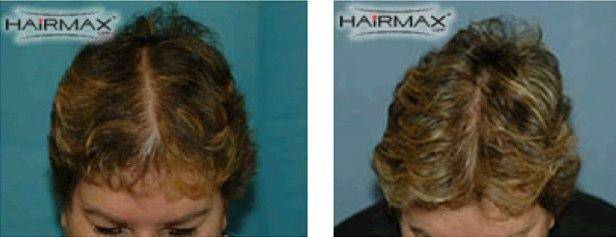 HairMax Before & After Results