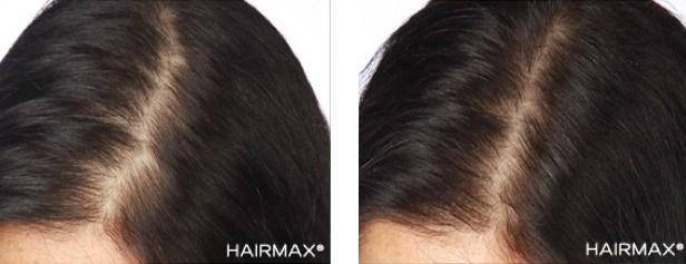 HairMax Before & After Results