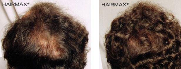 HairMax Before & After Results