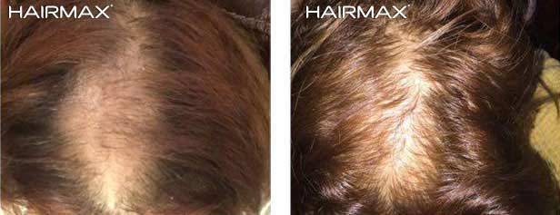 HairMax Before & After Results