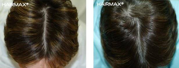 HairMax Before & After Results