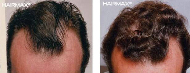 HairMax Before & After Results