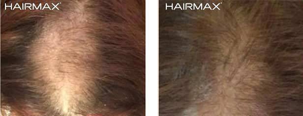 HairMax Before & After Results