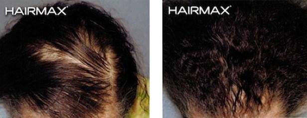 HairMax Before & After Results