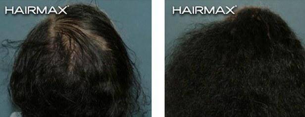 HairMax Before & After Results