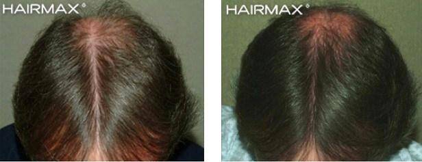 HairMax Before & After Results
