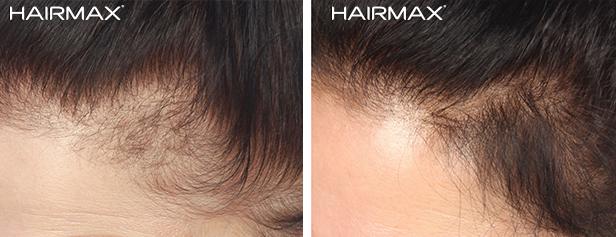 HairMax Before & After Results