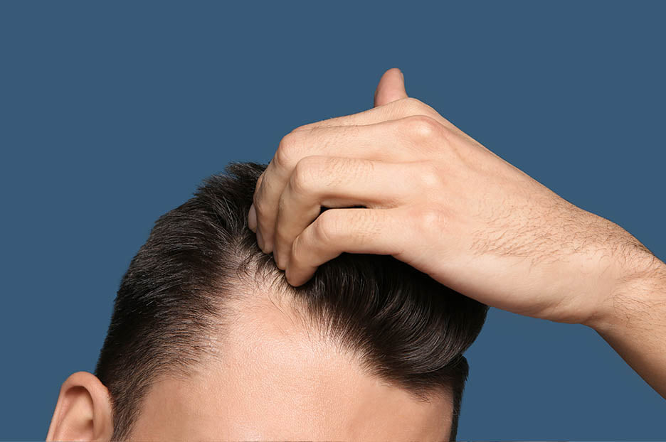 Hair Loss: How To Determine and Identify It's Stages