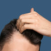 Hair Loss: How To Determine and Identify It's Stages