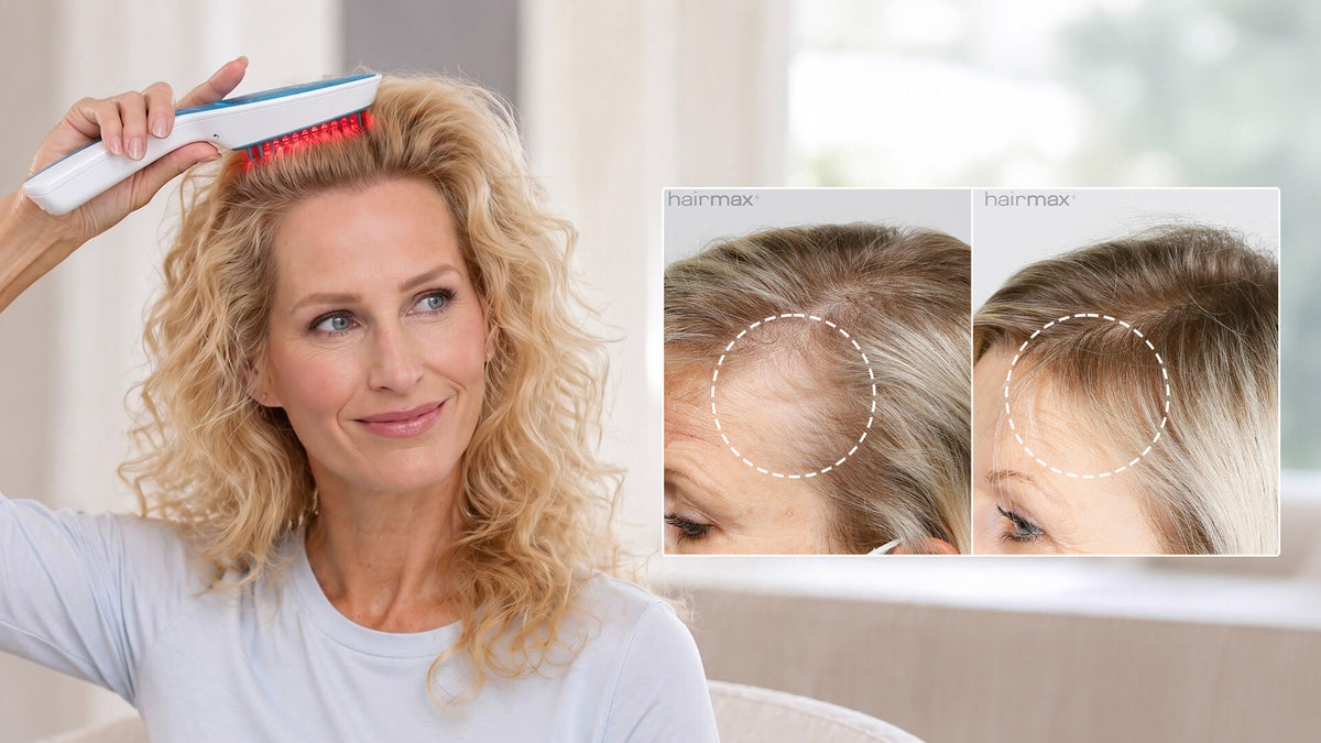 Hairmax Results: Month-by-Month Hair Regrowth Timeline