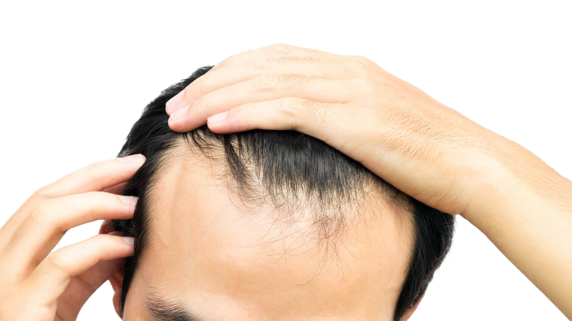 Hairline Starting To Thin? Learn What Causes It And How To Treat a Receding Hairline
