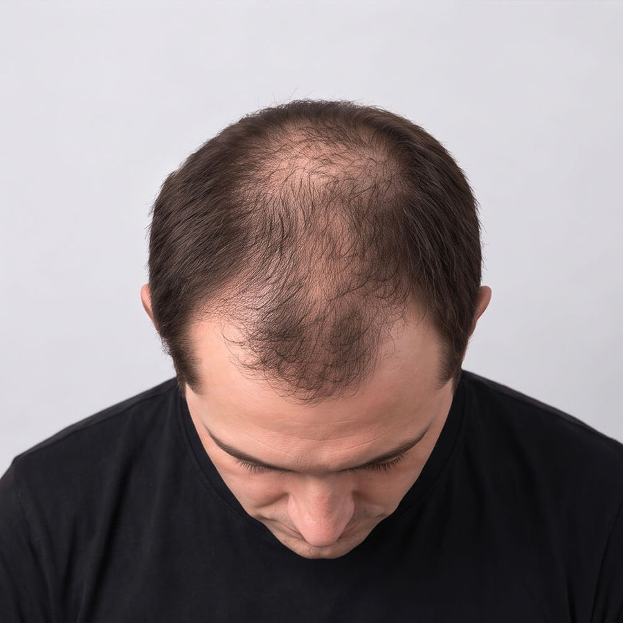 A close-up shot of a man looking down, showing thinning brown hair in advanced stages