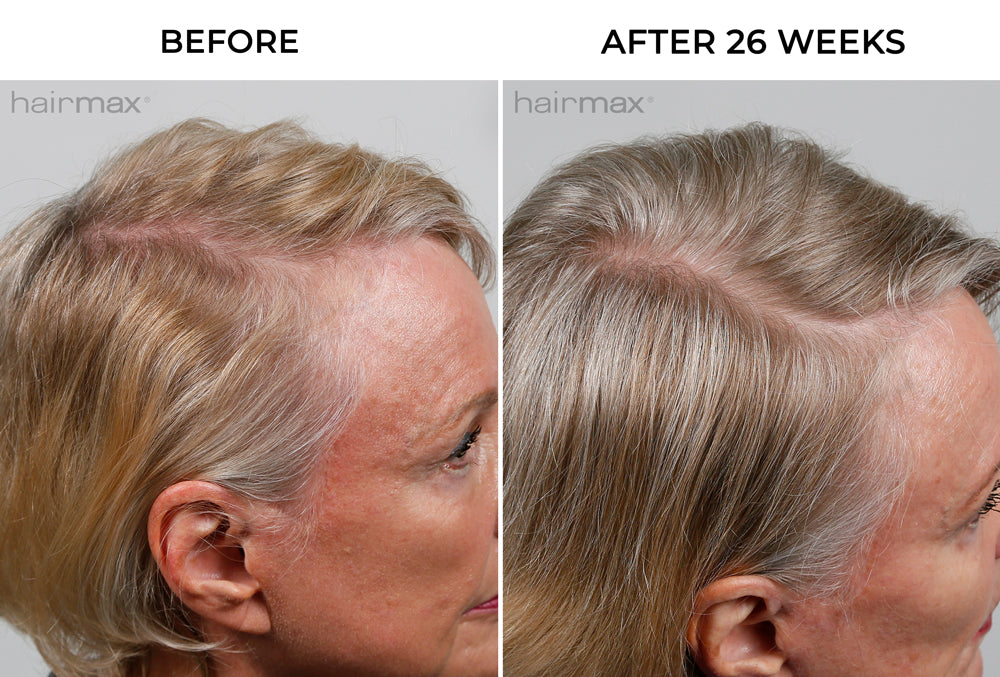 side-by-side before and after hair growth image