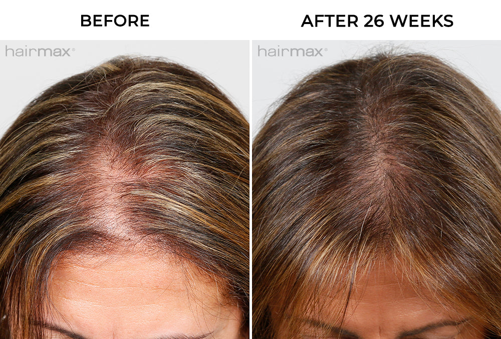 side-by-side before and after hair growth image