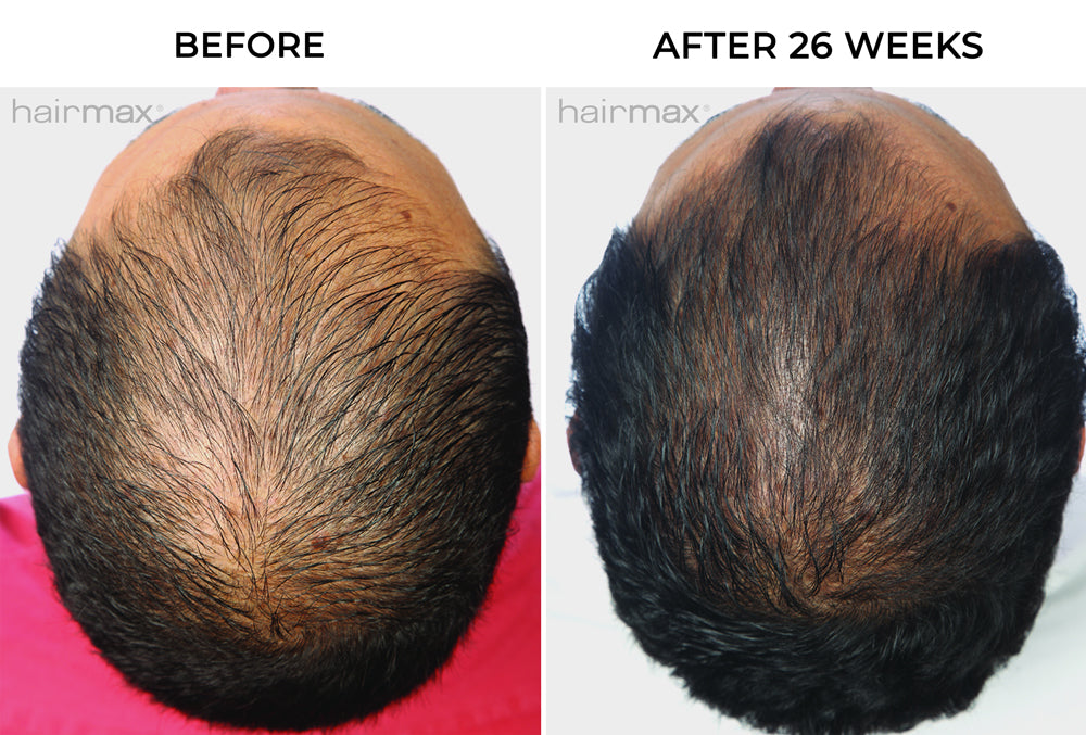 side-by-side before and after hair growth image