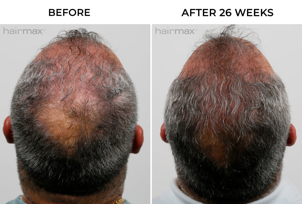 side-by-side before and after hair growth image