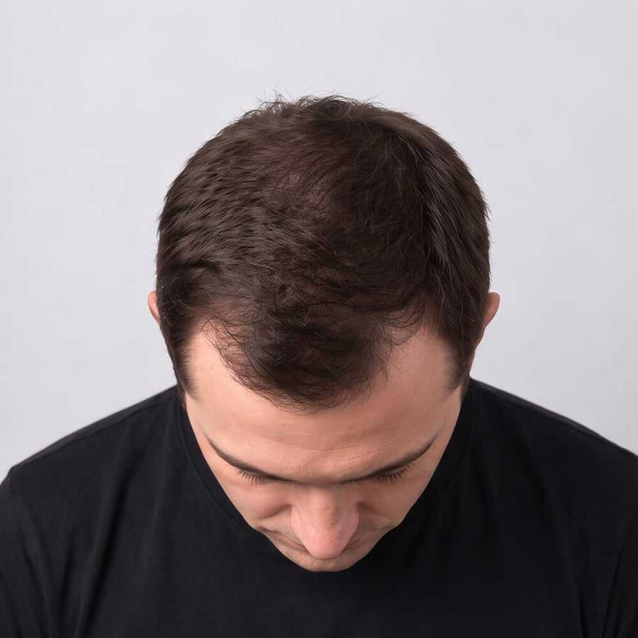 A close-up shot of a man looking down, showing thinning brown hair in mild stages
